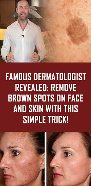 Famous Dermatologist Revealed: Remove Brown Spots On Face And Skin With This Simple Trick!