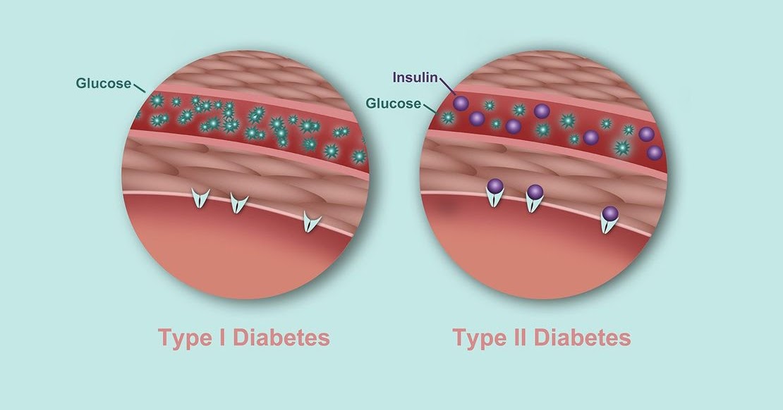 Insulin for sliding scale How sliding scale works, insulin is a