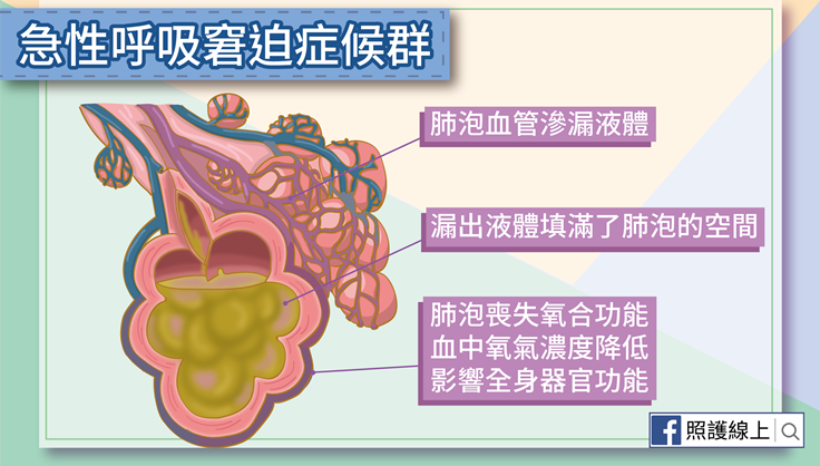 急性呼吸窘迫症候群