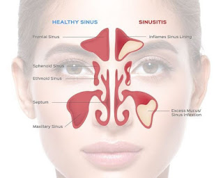 Best Homeopathic Remedy For Sinusitis Best Homeopathic Remedy For Sinusitis