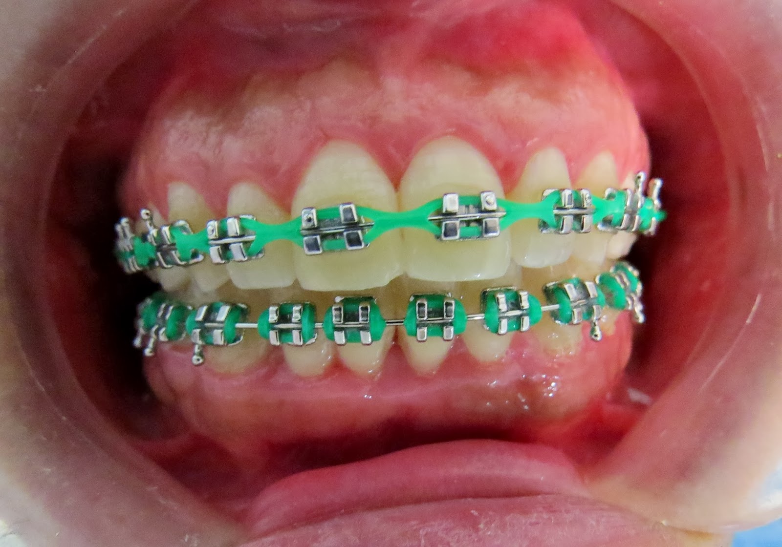 Legature Elastiche - LoSHOPPING DENTALe - Foto 5