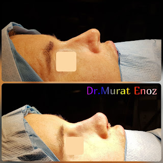 Micromotor Assisted Revision Nose Job, Micro-Motor Assisted Revision Rhinoplasty Operation,Revision Nose Aesthetic Operation in Turkey,