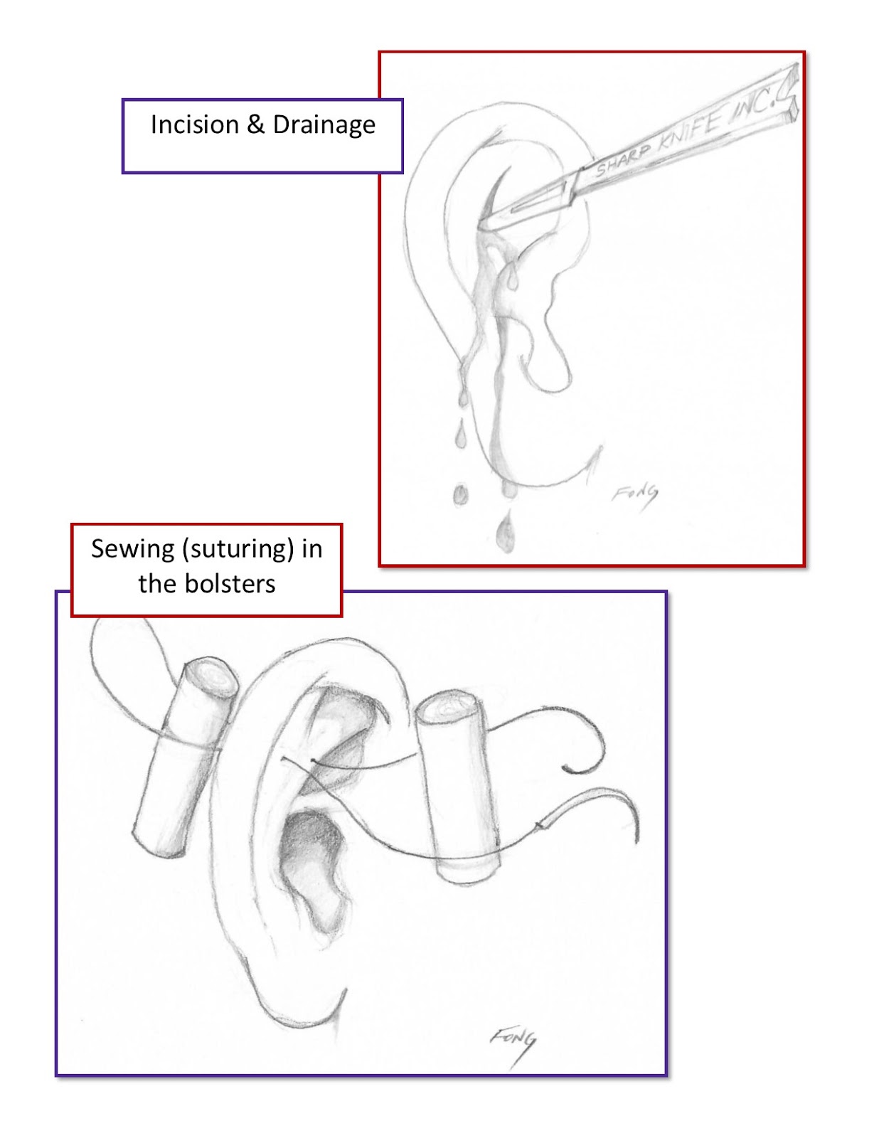 “Cauliflower” Ear or Auricular Hematoma