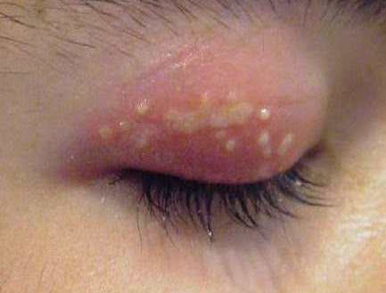 https://1.bp.blogspot.com/-bJUJPuQewLE/WNIjB9mLcWI/AAAAAAAAAZo/b62rGk-9p-woJCG-R2k8e94Gx2nwlxwcwCLcB/s1600/herpes%2Bdi%2Barea%2Bmata.jpg
