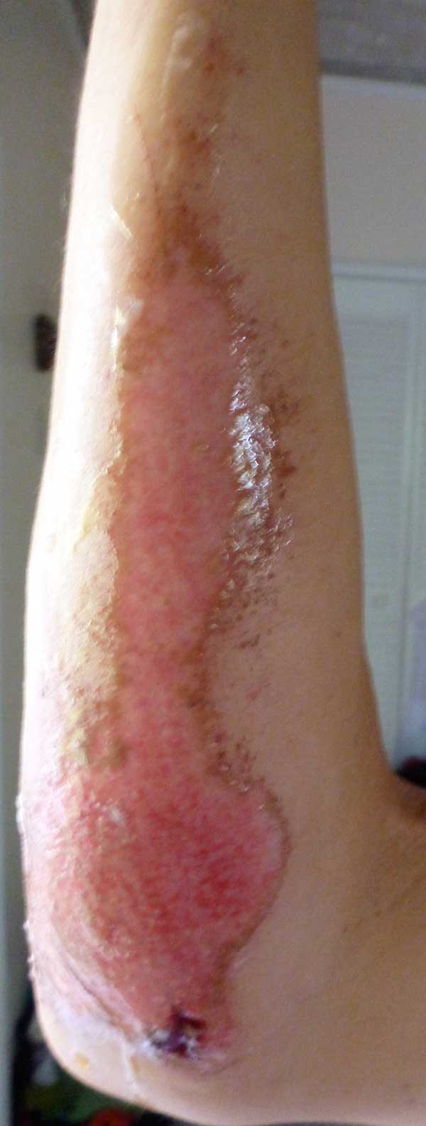 Charisa Wernick Road Rash Update