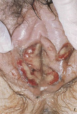 labia ulcer
