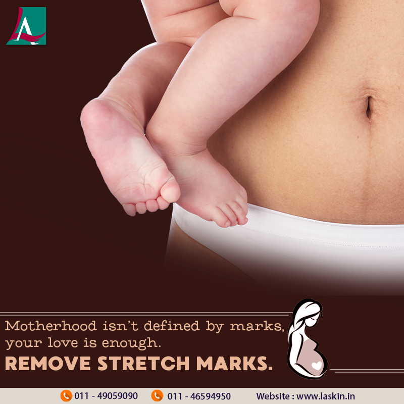 Stretch Marks Removal in India