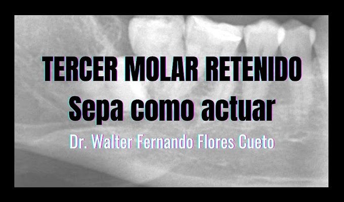 TERCER MOLAR RETENIDO: Sepa como actuar - Dr. Walter Fernando Flores Cueto