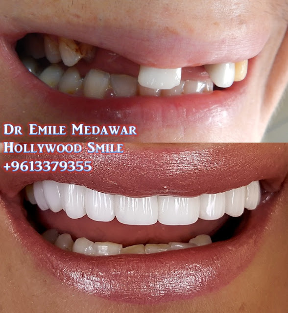Hollywood Smile Veneers, Dr Emile Medawar, 00 961 3 379355 veneers cost