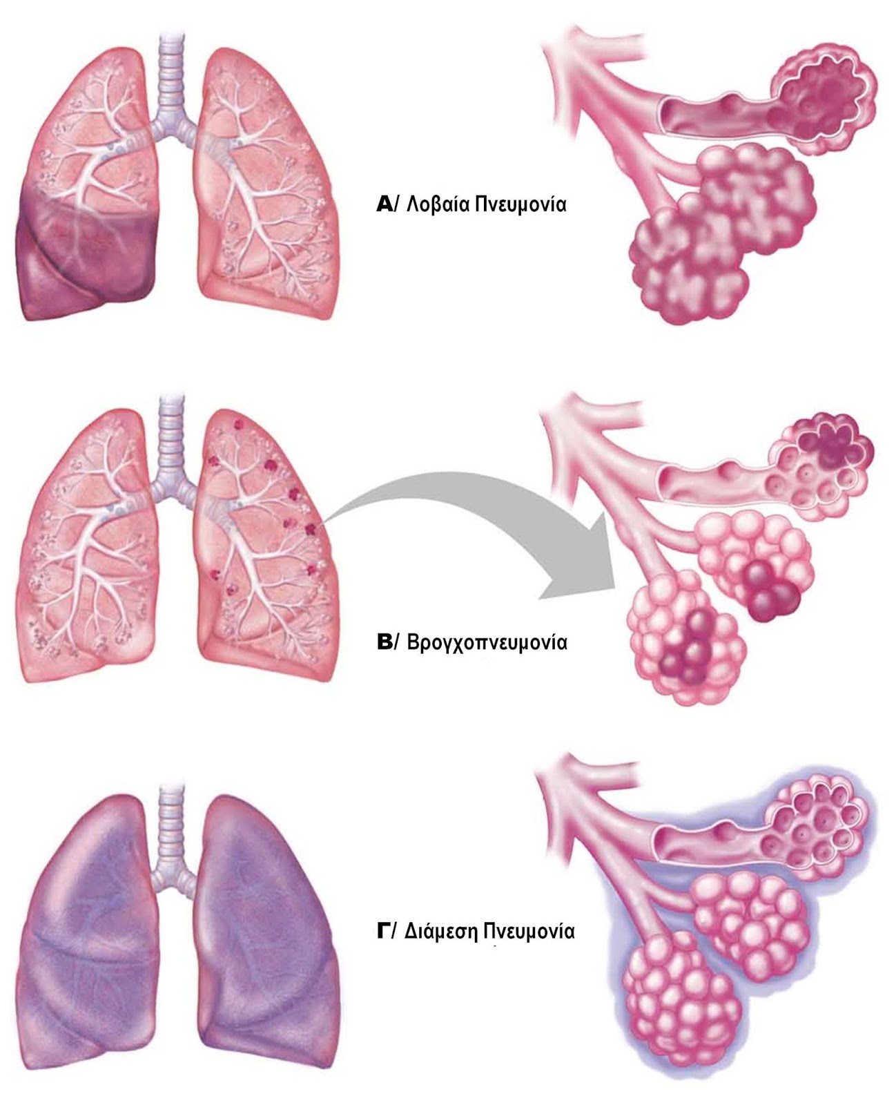 Пневмония легких осложнения