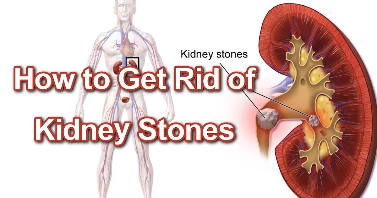 can taking calcium carbonate cause kidney stones