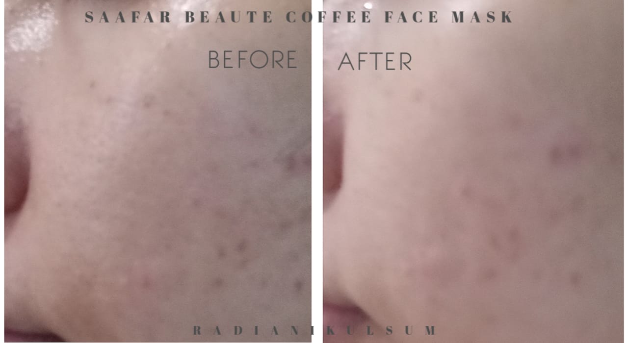 before-after pemakaian masker coffee Saafar Beaute di pipi kanan
