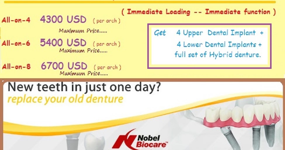 allon4 Dental Implants, allon4 Dental Implant price India, Dental