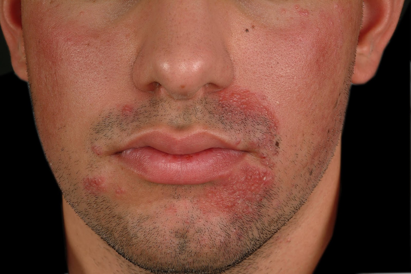 tudo-sobre-micoses-tinea-barbae
