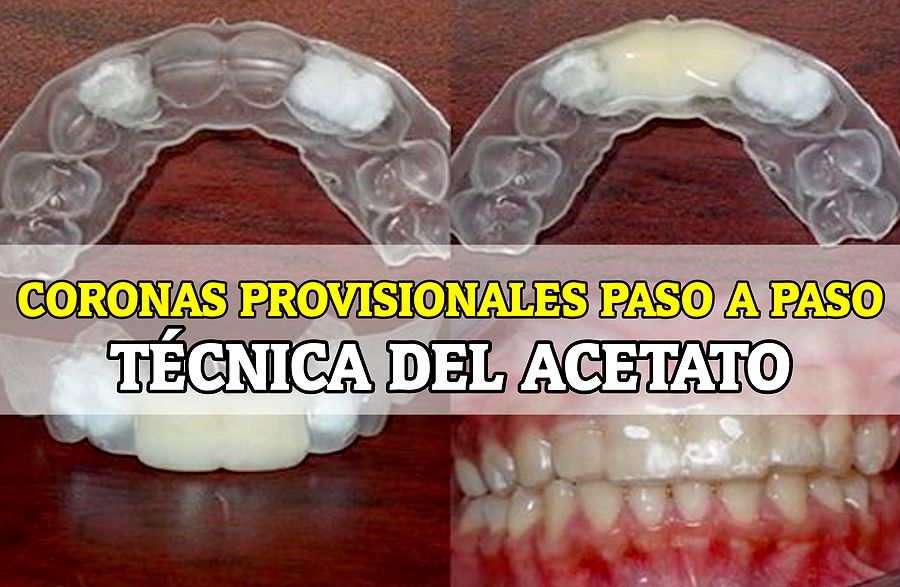 CORONA PROVISIONAL Técnica del Acetato paso a paso
