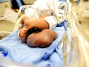 brain outside head baby south africa