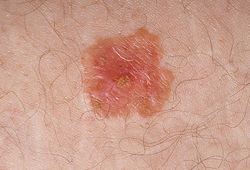 Basal Cell Carcinoma (BCC) - SkinCancer.org