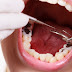 Phương pháp điều trị sâu răng an toàn nhất