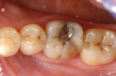 Bệnh sâu răng được chữa trị như thế nào?