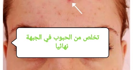 التخلص من البثور الموجودة في الجبهة