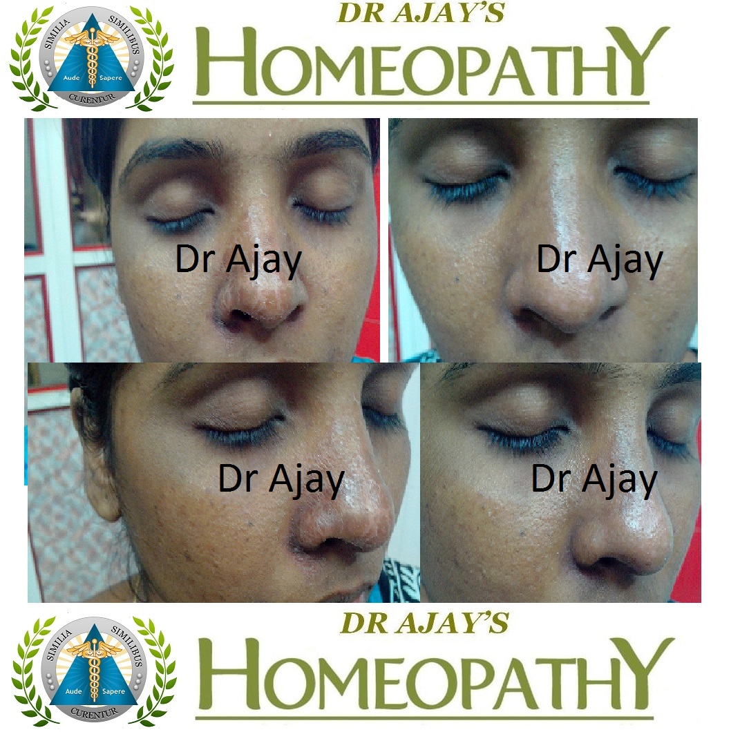 Dr Ajays Homeopathy Homeopathy For Xerosis Of The Skin Dry Skin