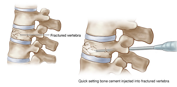 medic tratament coloanei vertebrale durere unde articulația șoldului