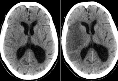 Radiology MRI: Acute MCA Infarct on CT