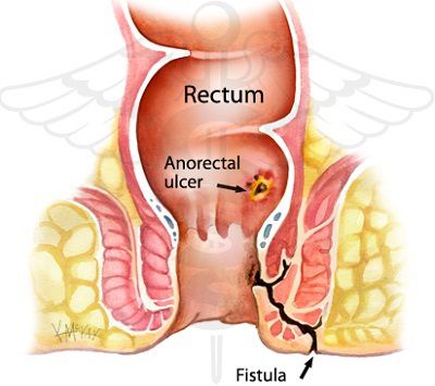 Image result for anoractal fistula
