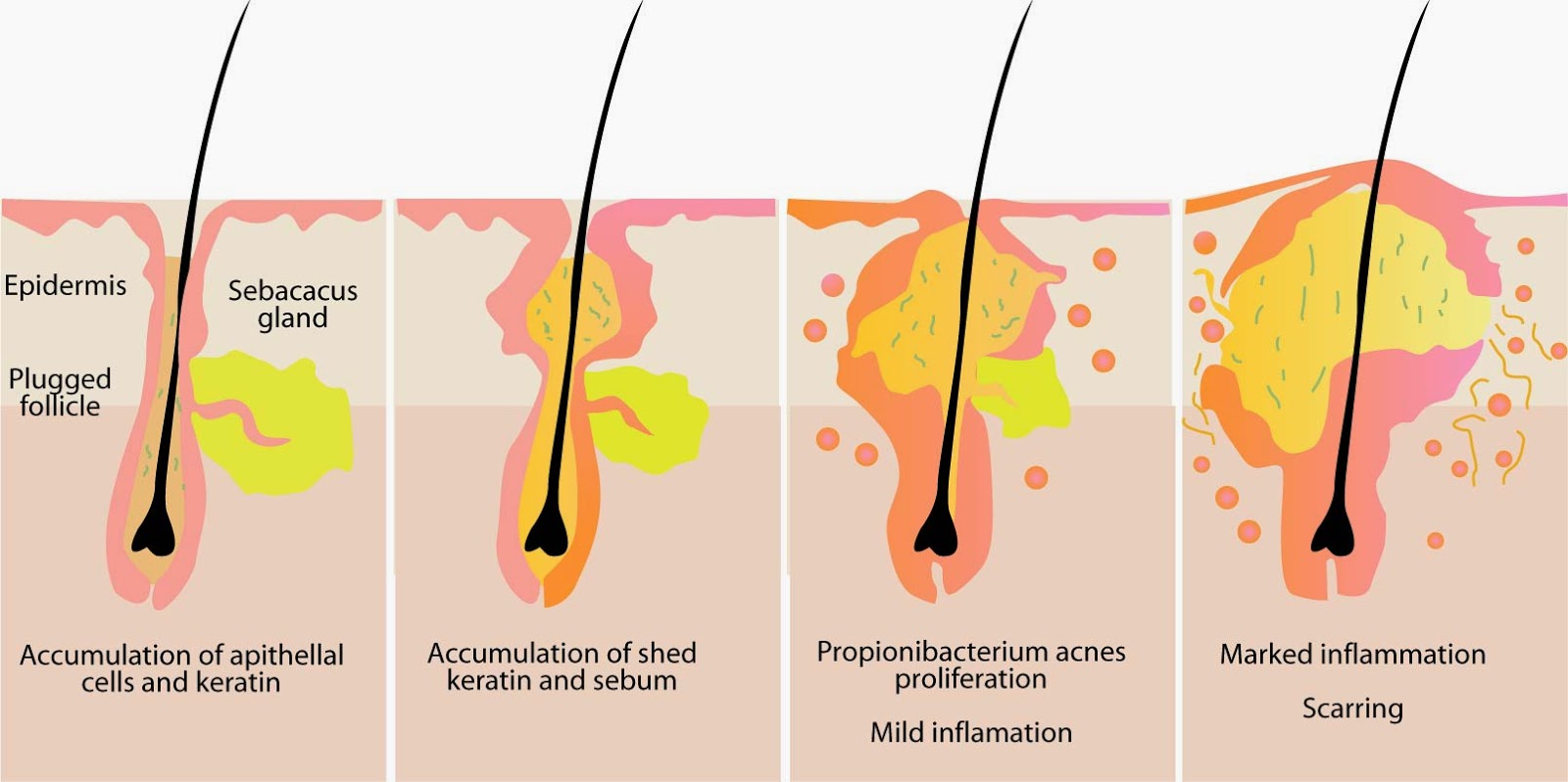 Menangani masalah jerawat ~ Start here