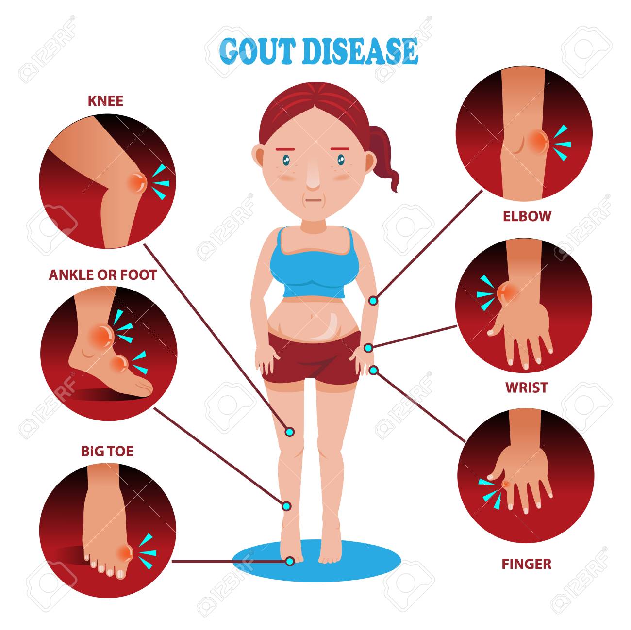 Penyakit Gout Itu Apa (5 Gambar)