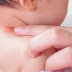  Cara Menyembuhkan Alergi Anak dengan Mudah 