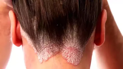 What is Psoriasis? What is Psoriasis?