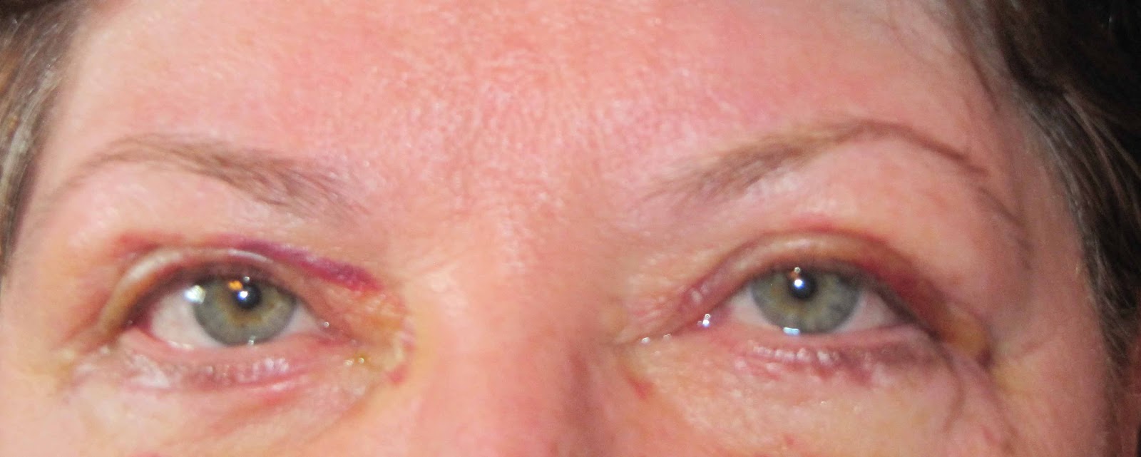 My account of puffyeye surgery (blepharaplasty) August 2012