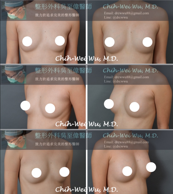2020最新自體隆乳案例，有效改善上胸的萎縮與不對稱的胸形