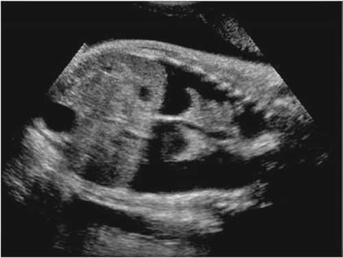 Bilateral pleural effusions