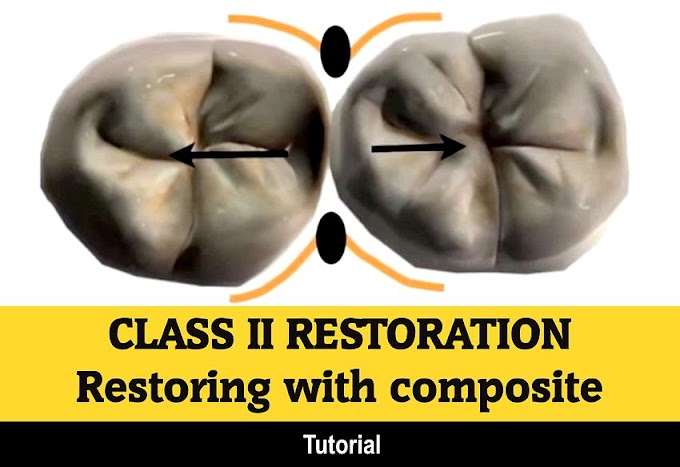 COMPOSITE RESTORATION: Restoring the difficult class II cavity with composite