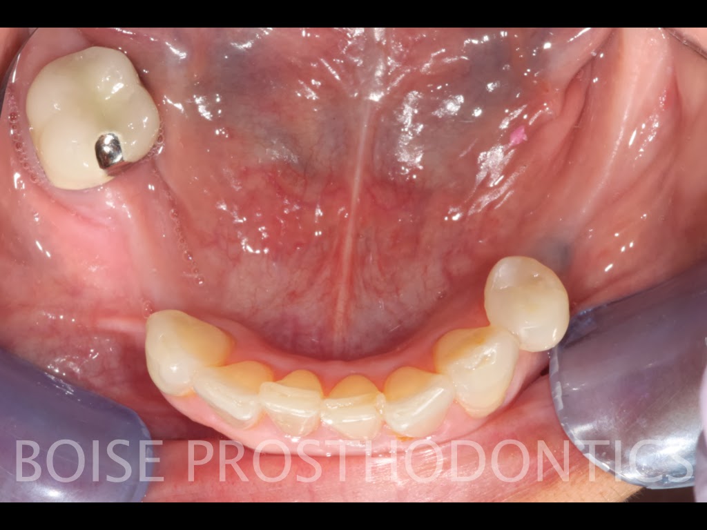 Boise Idaho Prosthodontics Maxillary Teeth and Mandibular Semiprecision Removable Partial