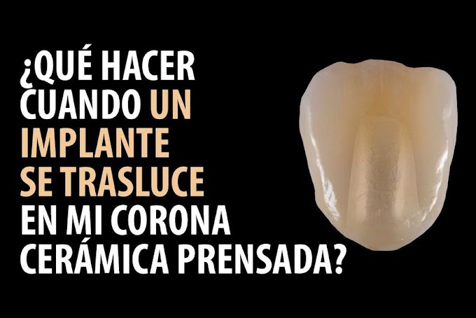CORONA DE PORCELANA: ¿Que hacer cuando un implante se trasluce en mi corona de cerámica prensada?