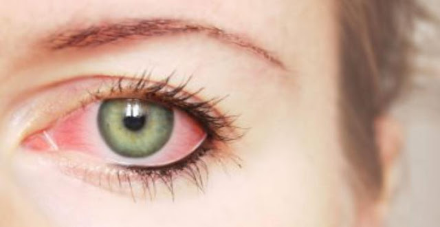 مرض الرمد الربيعي مرض الرمد الربيعي