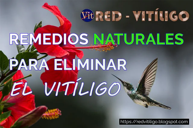 TRATAMIENTOS NATURALES PARA EL VITILIGO