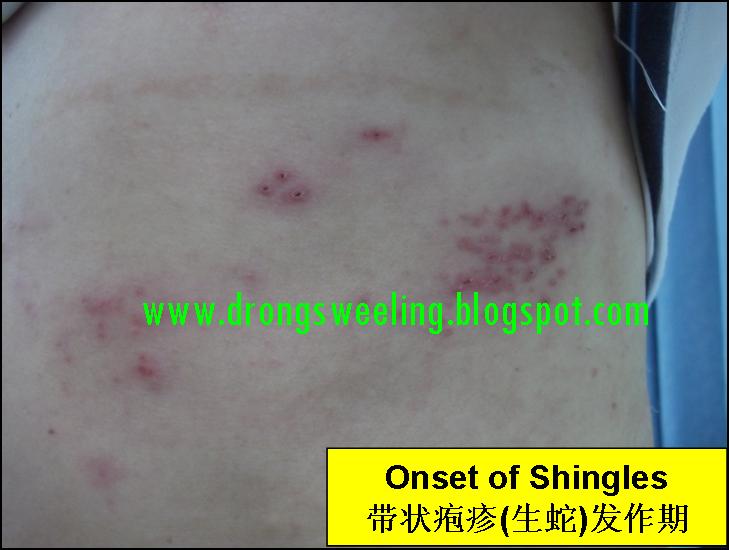 TCM News Best TCM Doctor for Shingles, Herpes Zoster, Postherpetic Neuralgia