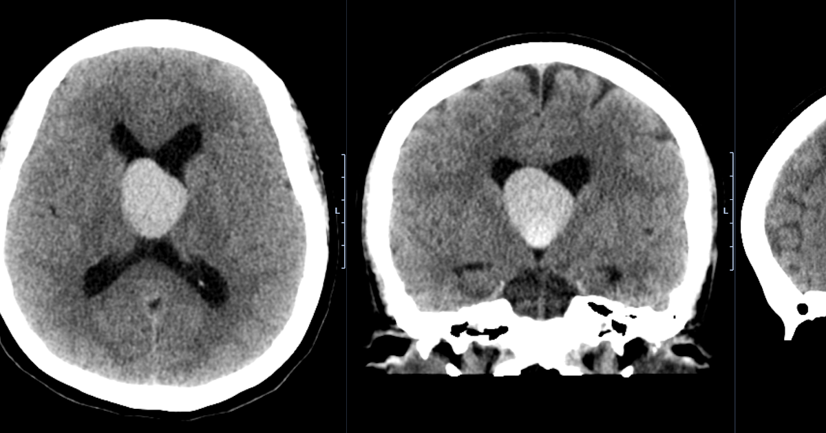 Large Colloid Cyst