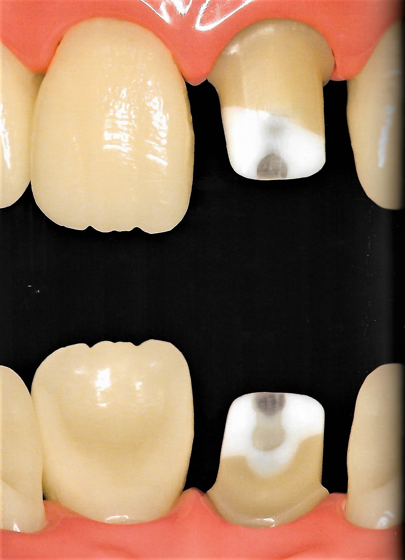 Anterior Crown Preparation Dental Esthetics