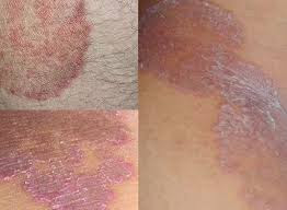 CARA MENYEMBUHKAN GATAL SELANGKANGAN DENGAN BUMBU DAPUR CARA MENYEMBUHKAN GATAL SELANGKANGAN DENGAN BUMBU DAPUR