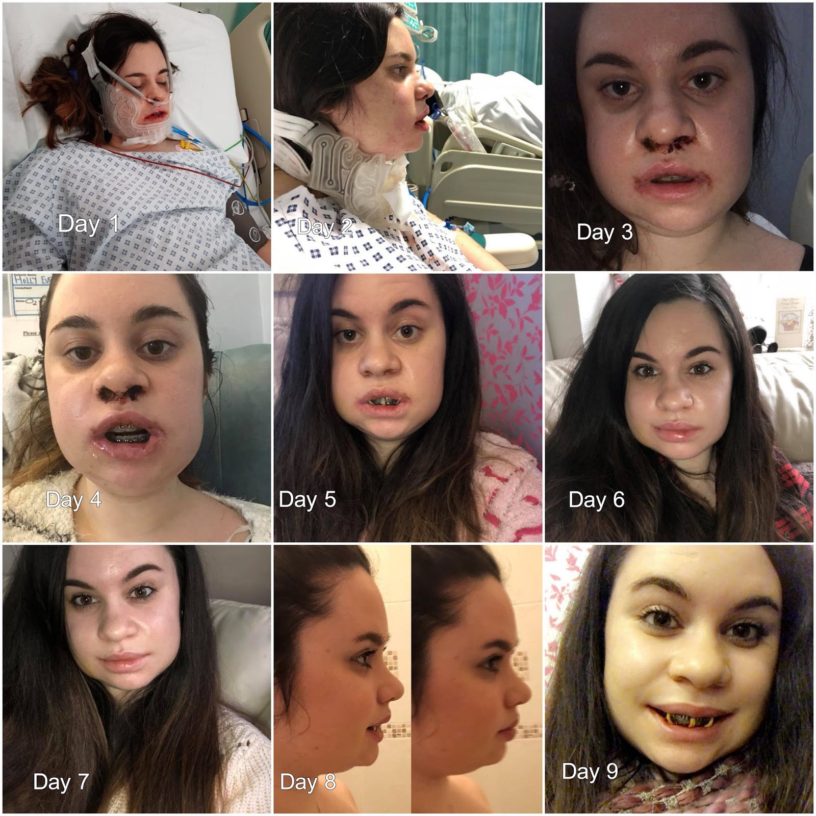 Double Jaw Surgery The Recovery