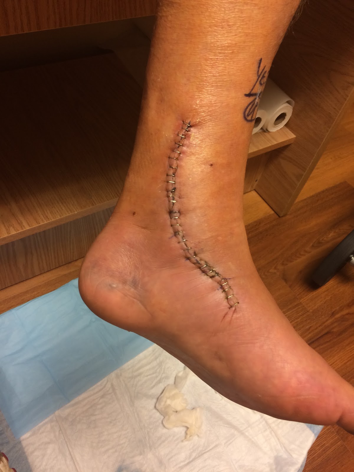 Eric Banks' Blog: Posterior Tibial Tendon Surgery, 10 days post-op