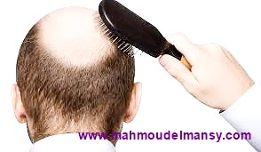 تساقط الشعر|| أسبابة وطرق الوقاية والعلاج والسبب الرئيسي لحدوث الثعلبة
