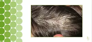 scalp buildup scalp buildup
