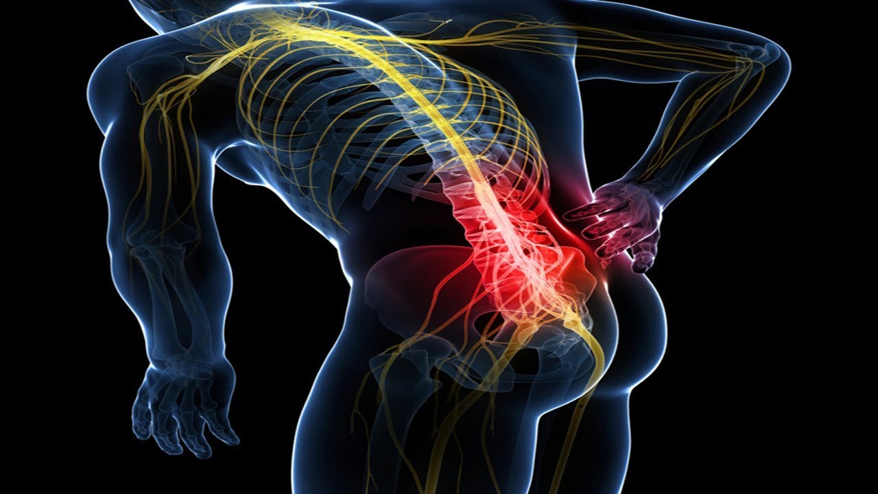 Tratamiento natural para dolor nervio ciatico