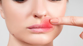 facts on cold sores 